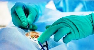 Mengenal Operasi LASIK, Solusi Canggih untuk Mata Minus yang Bikin Hidup Lebih Simpel dan Nyaman
